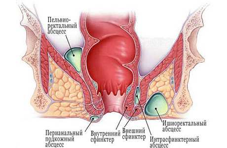 Симптомы и лечение парапроктита у грудничков